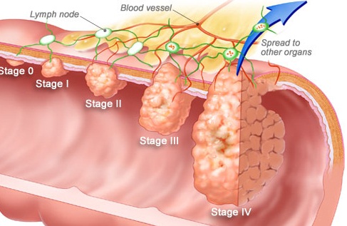 winslow_rm_illustration_of_colorectal_cancer_stages
