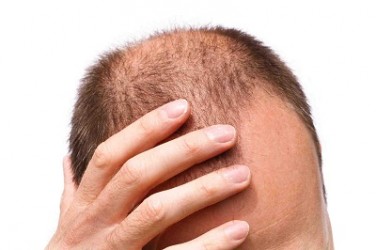 hairlossworry