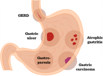 gastric-disorders-Treatment